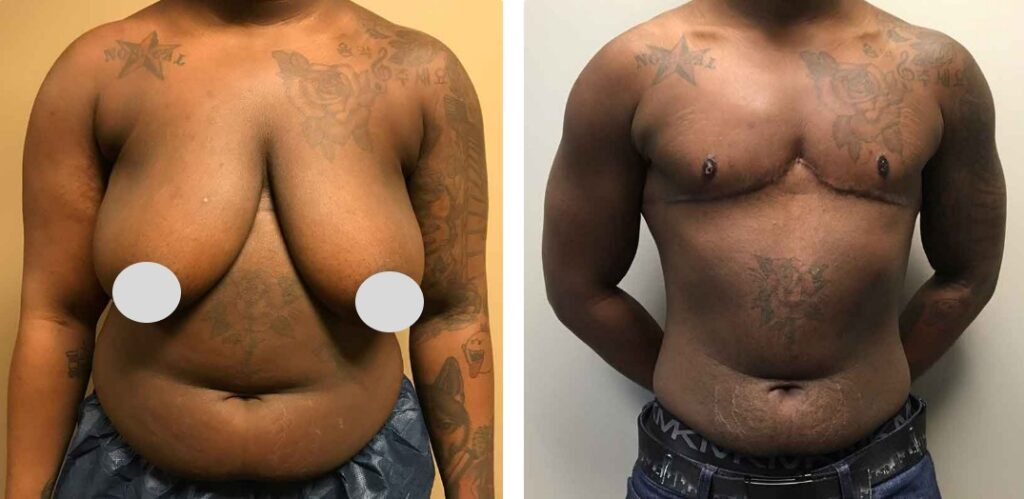 FTM Top Surgery before and after