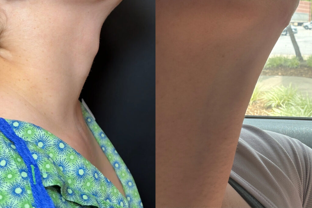 Tracheal Shave