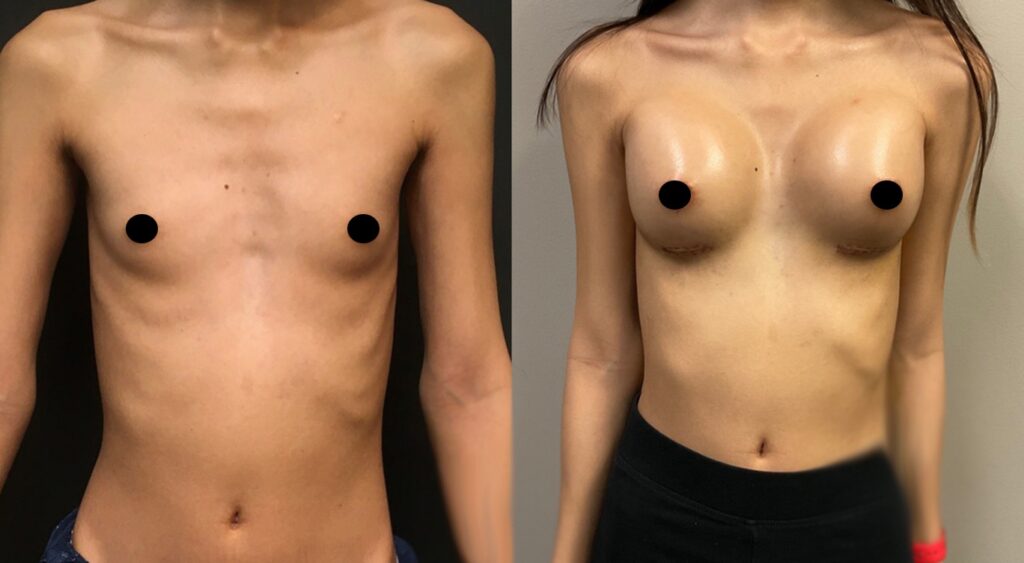 MTF Body Feminization Before and After Results