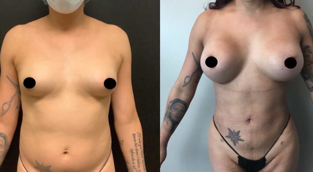 MTF Body Feminization Before and After Photos