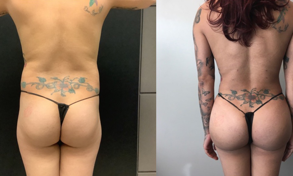 MTF Body Feminization Before and After Images