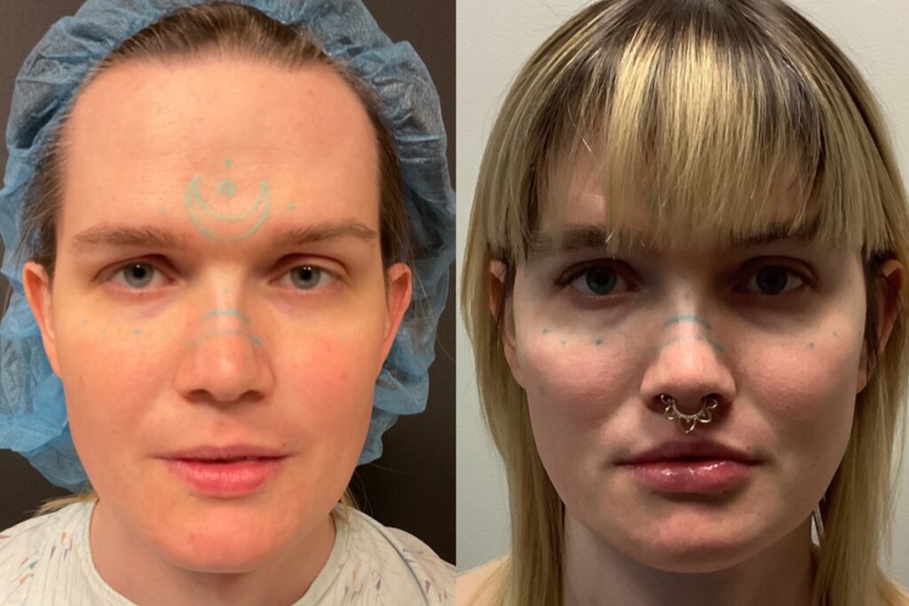 Facial Feminization Before and After