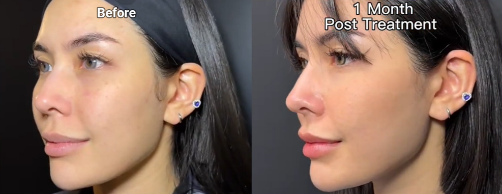 Rejuran Before and After