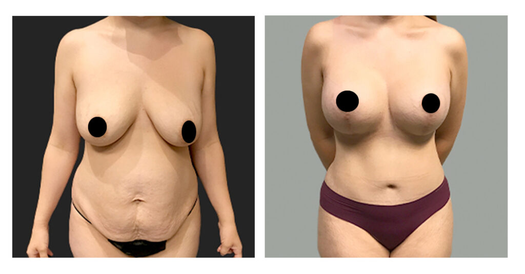 All in one Mommy Makeover Before and After
