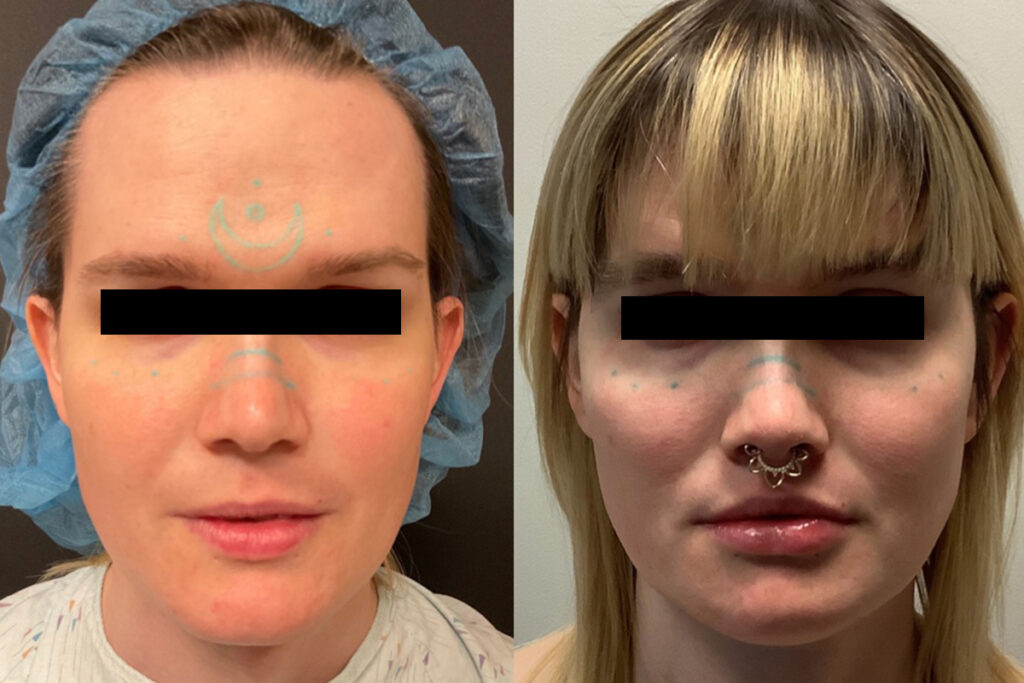 Before and After Results