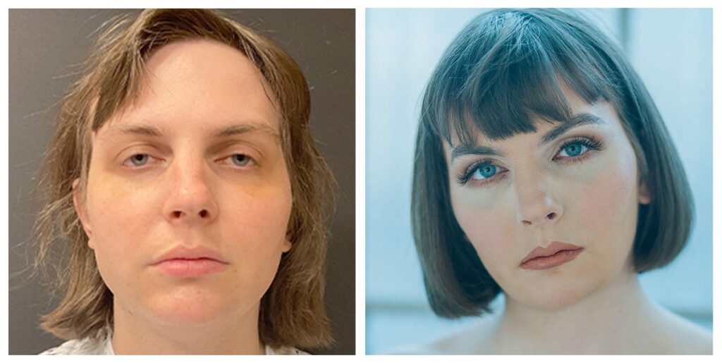 FFS Before and After Image
