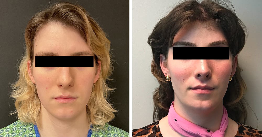 Facial Feminization Before and After