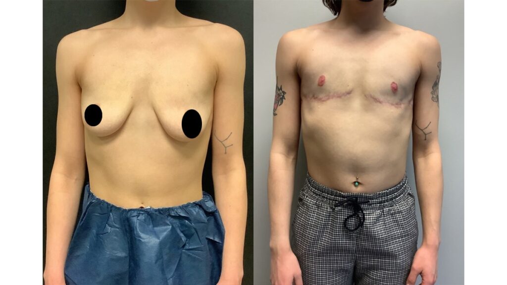 FTM Top Surgery Before and After Results