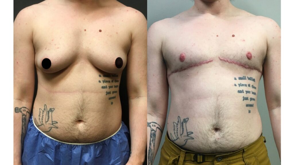 FTM Top Surgery Before and After Photo