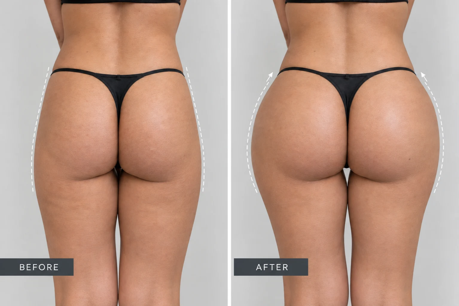 AlloClae BBL Before and After