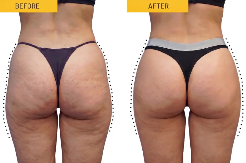 AlloClae Before and After Results