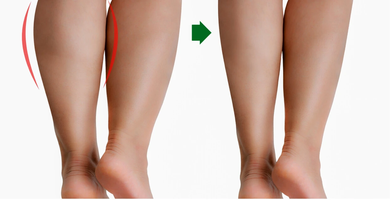 Benefits Of Botox For Calves