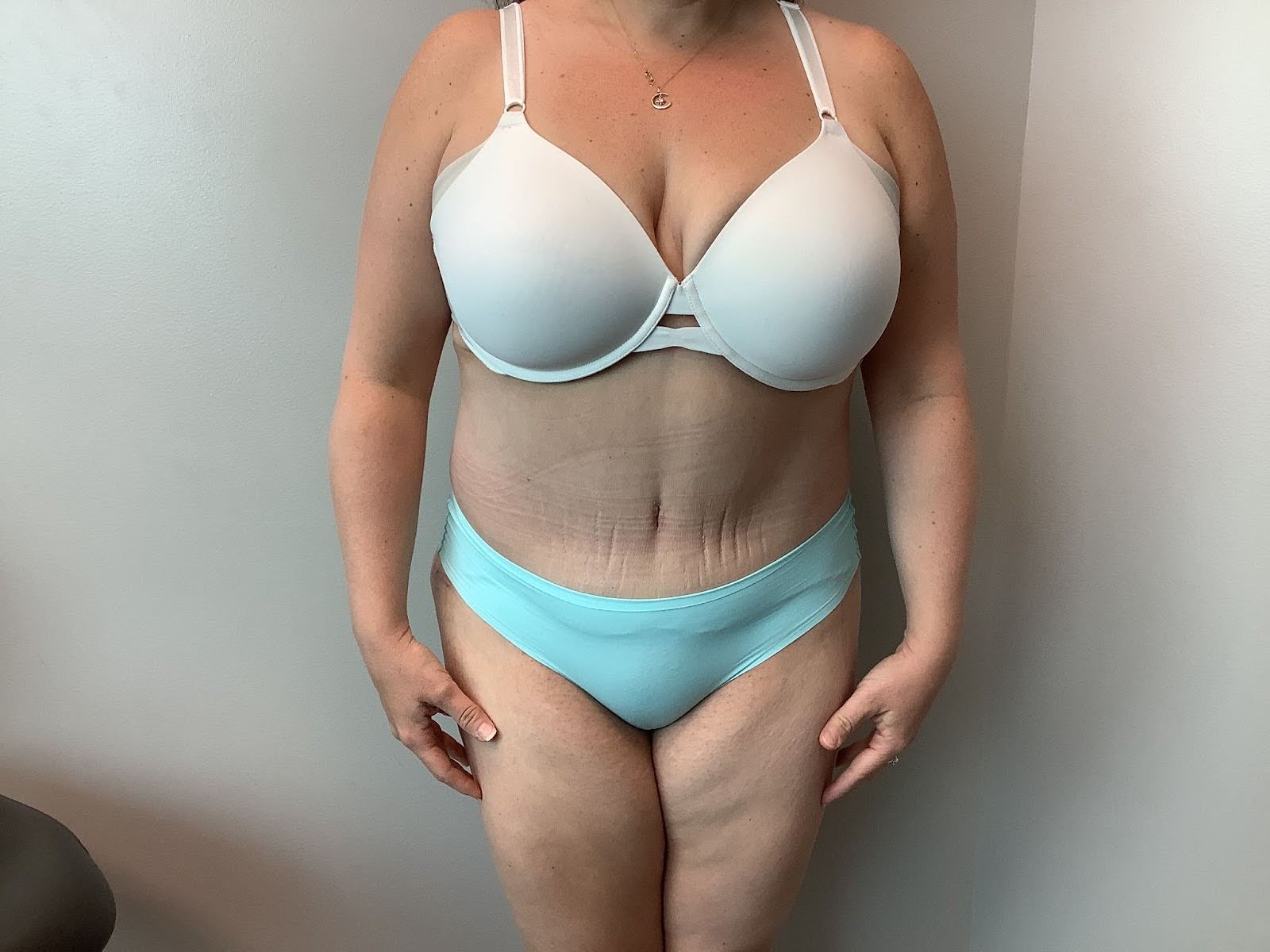 Extended Tummy Tuck 01