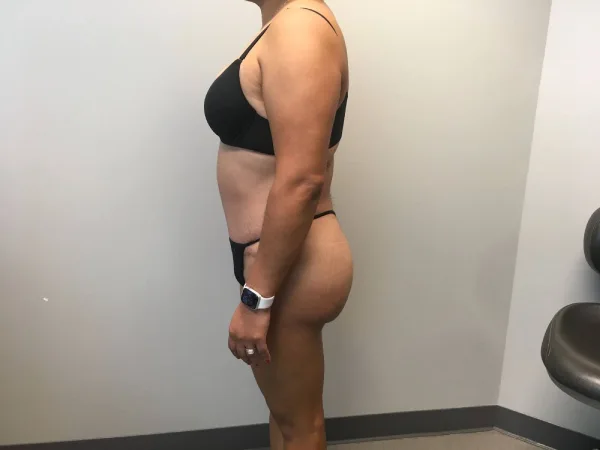 Modal showing extended tummy tuck
