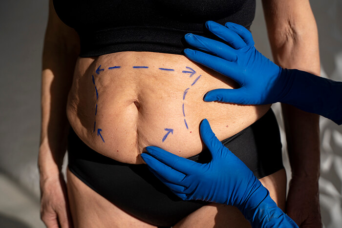 Best Fleur de lis Tummy Tuck in Seattle - Allure Esthetic