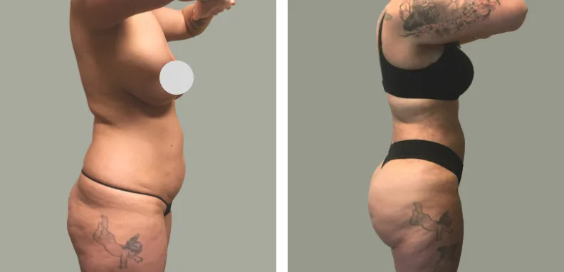 Lipo 360 W Bbl Before After 01