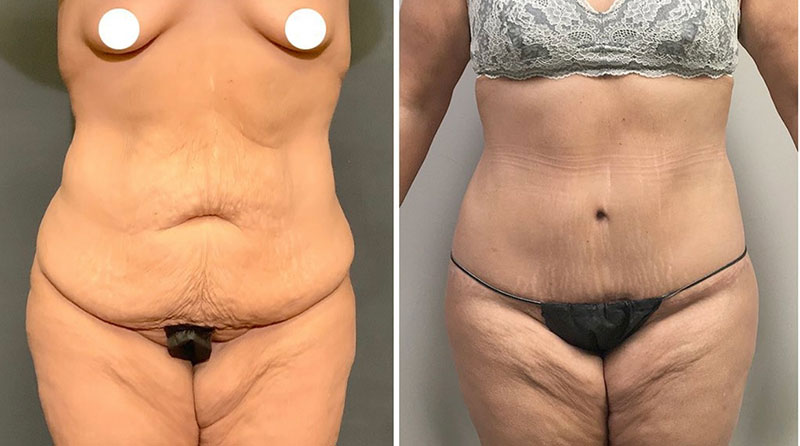 Liposuction Treatment Areas