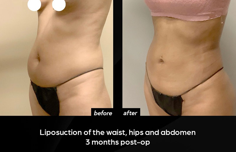 Liposuction Seattle