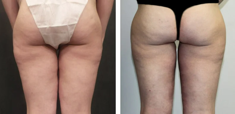 Thigh Lift Before After 02