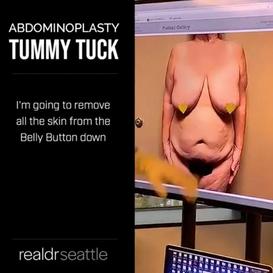 Tummy Tuck Seattle