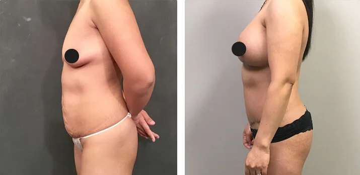 Mommy Makeover Tummy Tuck 02