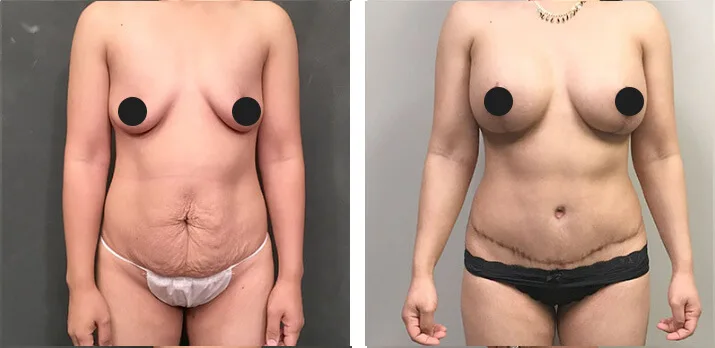 Mommy Makeover Tummy Tuck 03