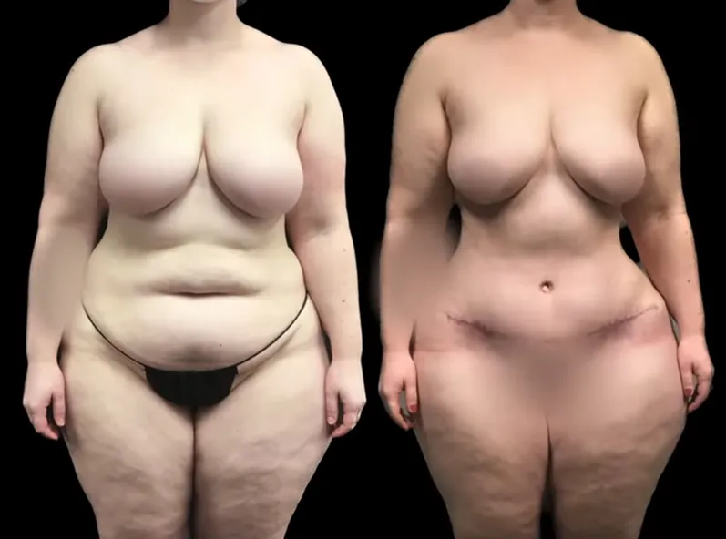 Tummy Tuck After Weight Loss Before After
