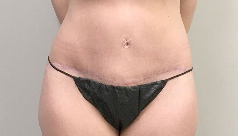Tummy Tuck Revision