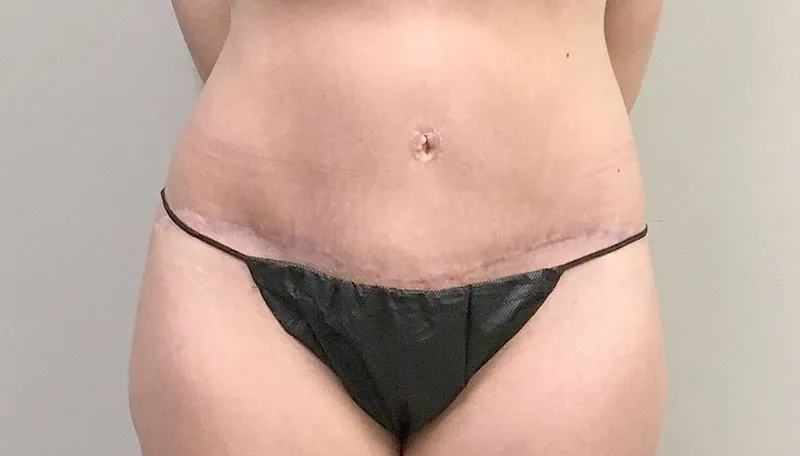 Tummy Tuck Revision