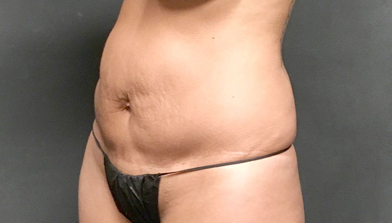 Tummy Tuck Revision