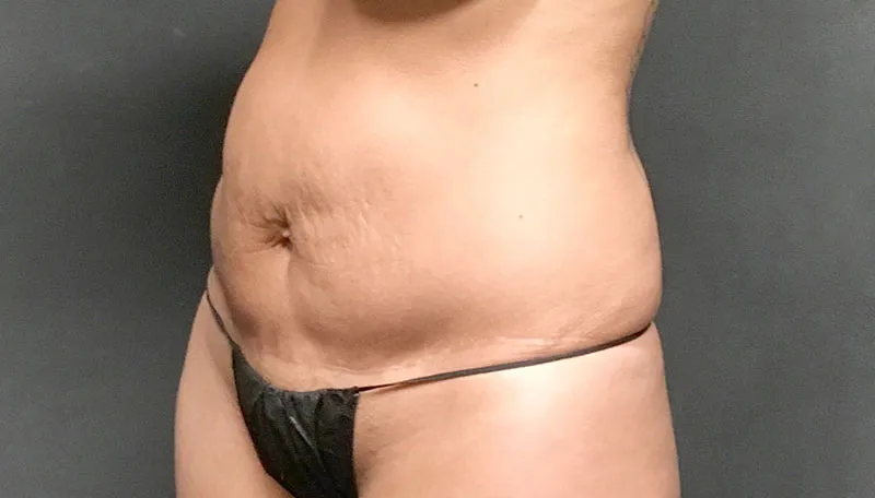 Tummy Tuck Revision