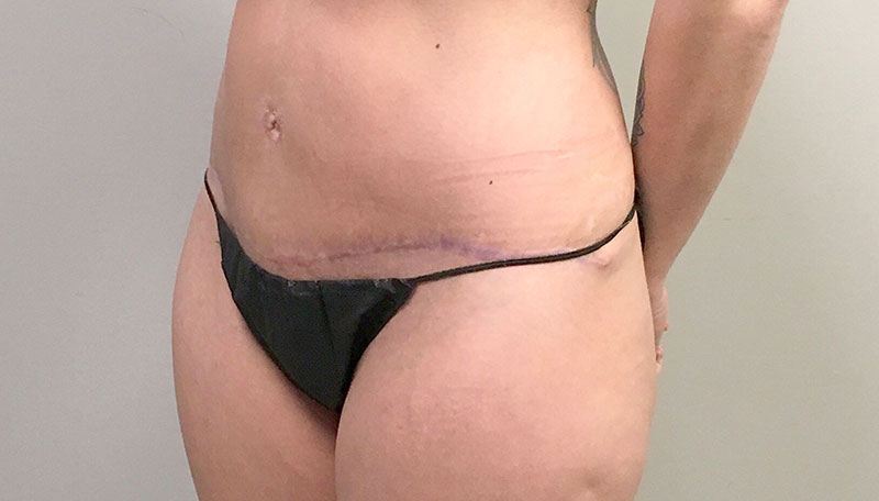 Tummy Tuck Revision