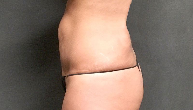 Tummy Tuck Revision