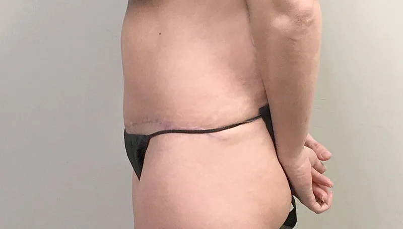Tummy Tuck Revision