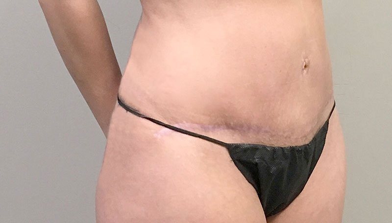 Tummy Tuck Revision