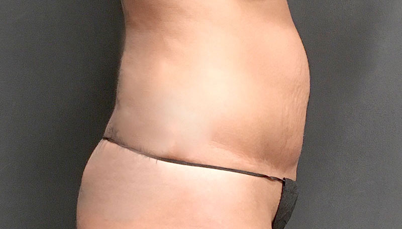 Tummy Tuck Revision