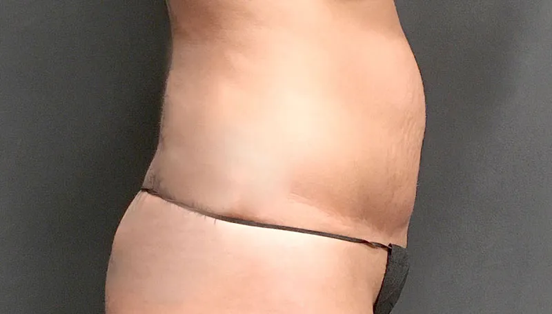 Tummy Tuck Revision