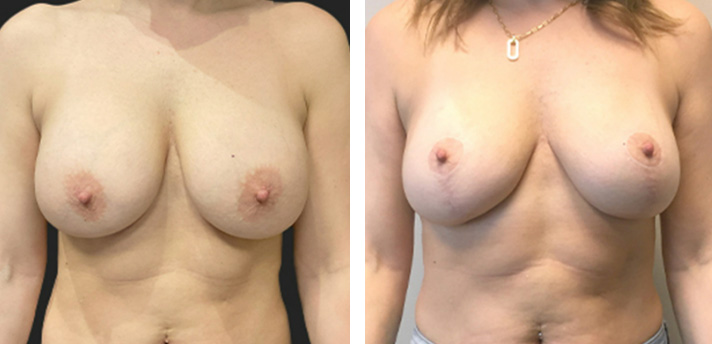 Breast Augmentation Revision 02