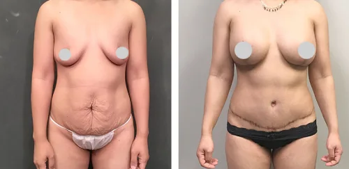 Breast Aug With Tummy Tuck Before After 01