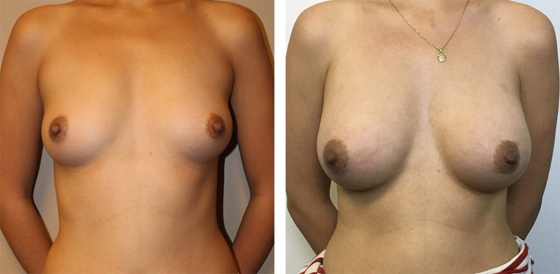 Breast Augmentation Surgery Seattle