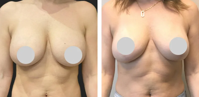 Breast Implant Exchange before and after 01
