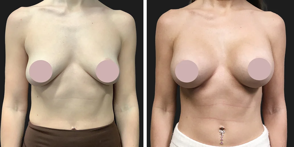 Breast Augmentation Before and After Gallery