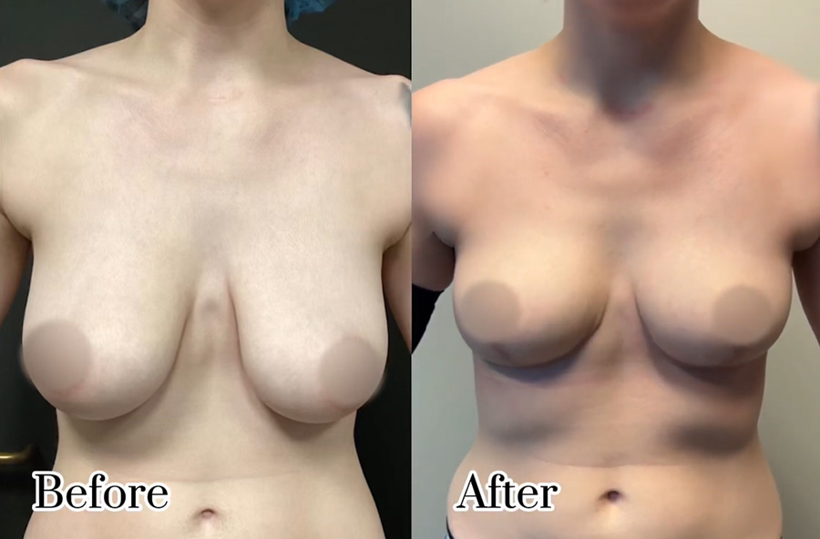 Breast Lift & Breast Reduction