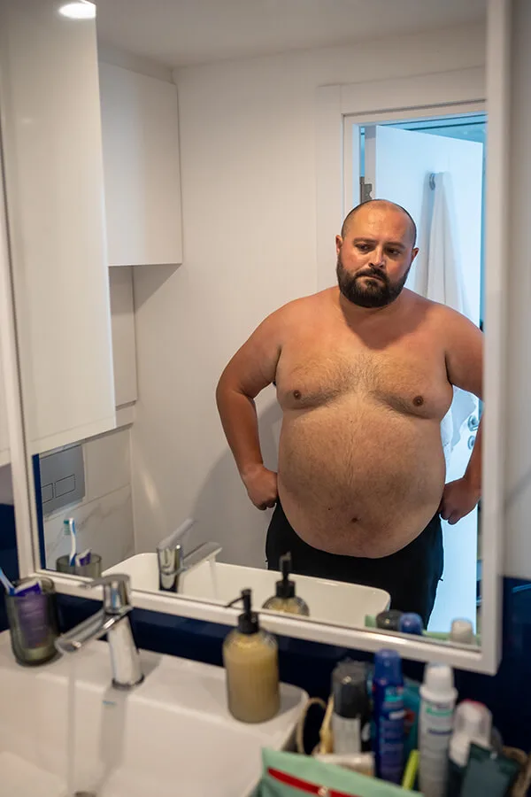 Gynecomastia Revision Allure 02