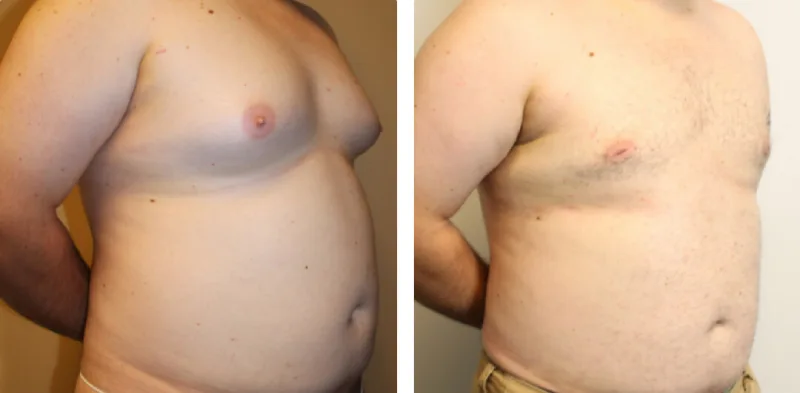 Before After 2