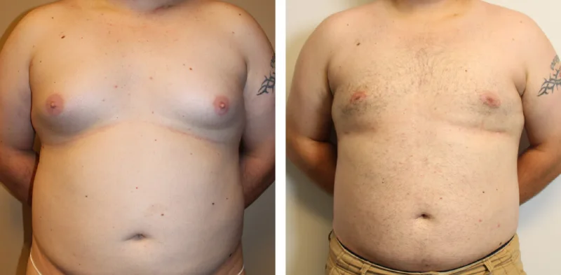 Before After