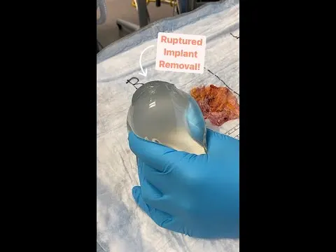 Symptoms of a Silicone Implant Rupture