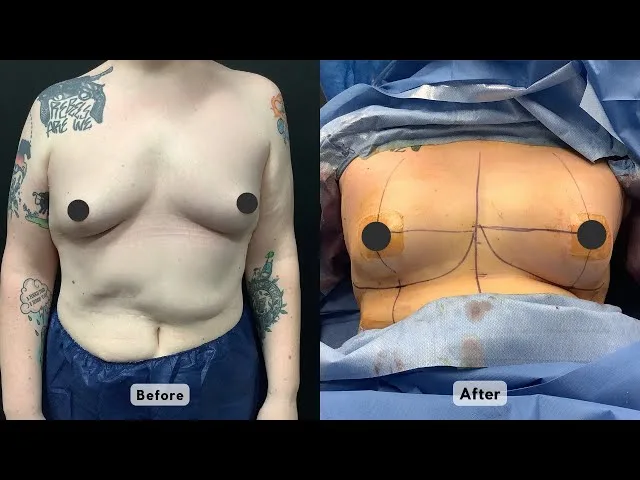 What Is The Typical Post Operative Recovery Like