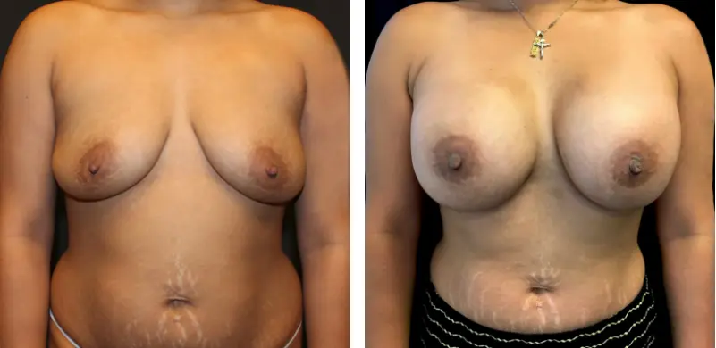 XL Breast Implants Before and After Results 02