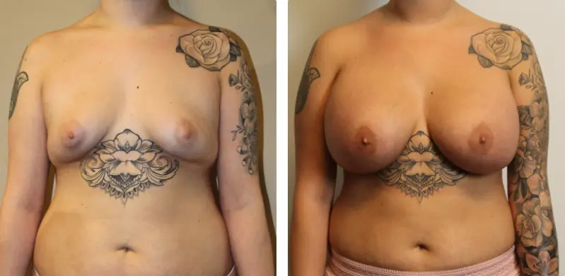 XL Breast Implants Before and After Results 03